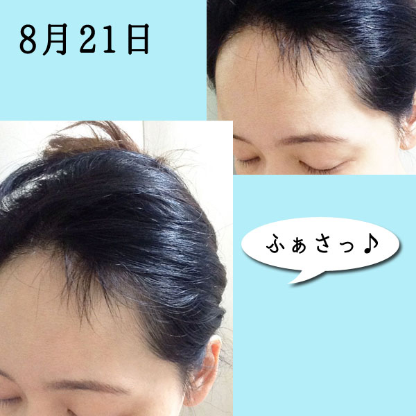 円形脱毛症完治