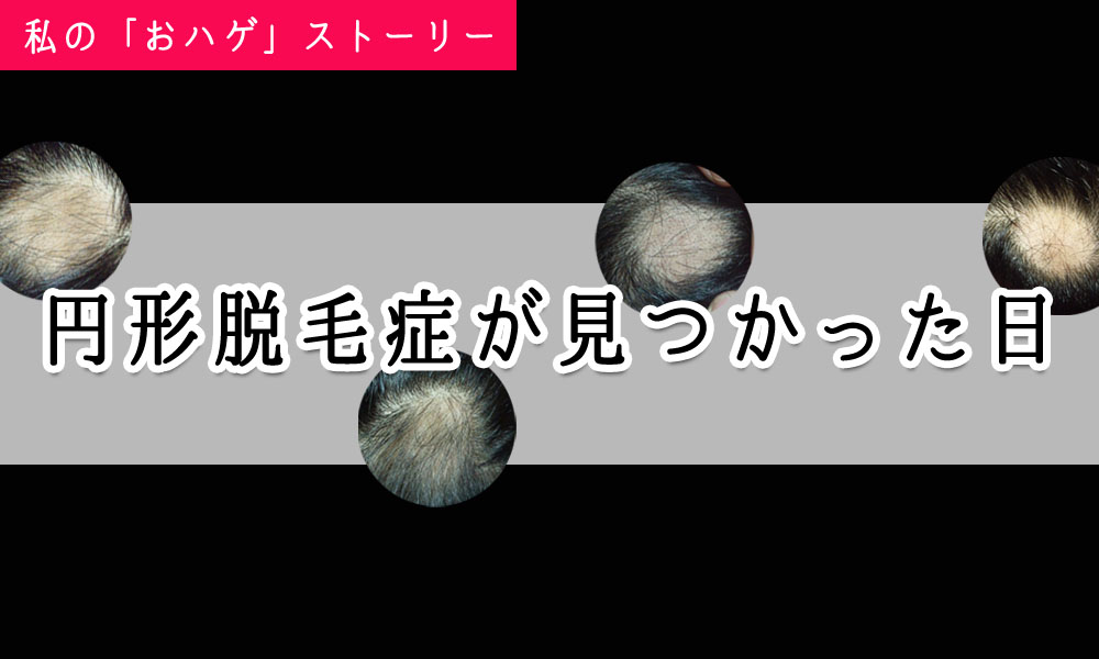 円形脱毛症が見つかった日