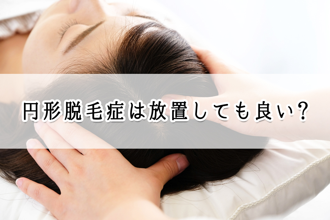 円形脱毛症は放置しても良いか?