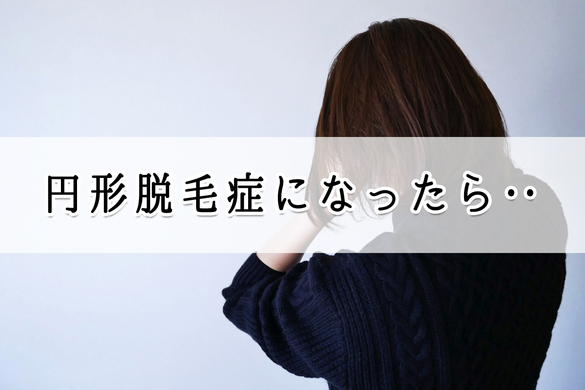円形脱毛症になったらすること